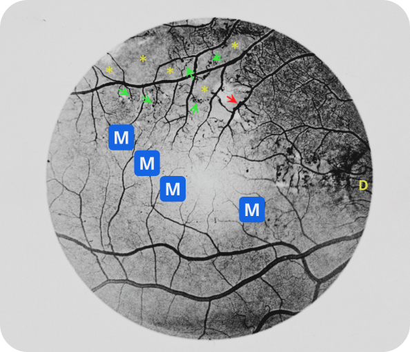 AI Detecting Chronic Diseases